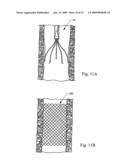 Minimally invasive medical device and method for delivery of therapeutic or diagnostic agents into a vessel wall diagram and image