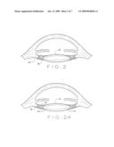 OPHTHALMOLOGICAL ZONULAR STRETCH SEGMENT FOR TREATING PRESBYOPIA diagram and image