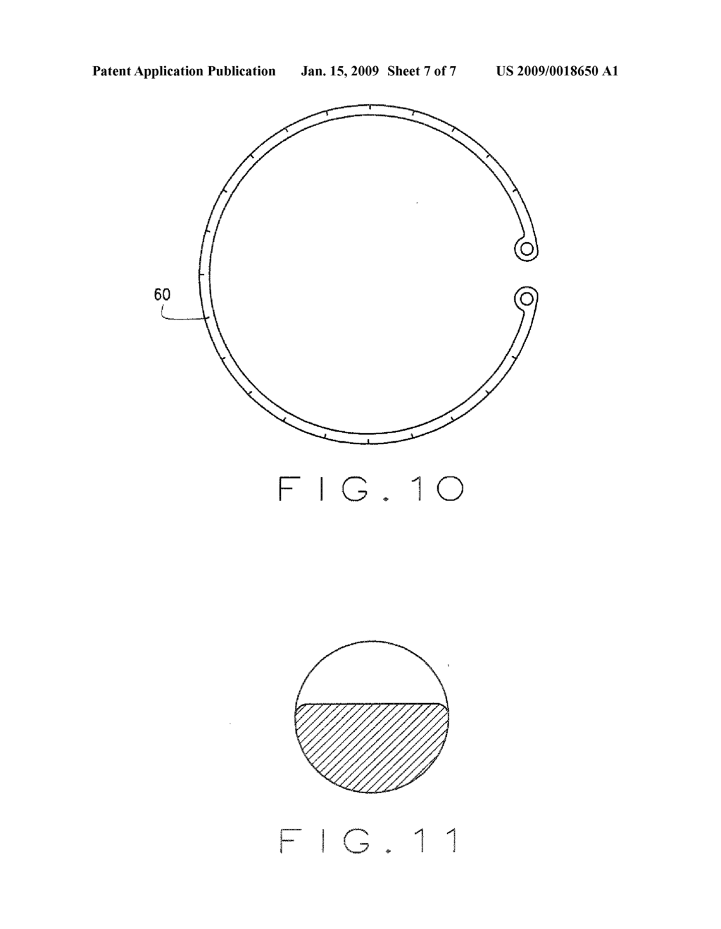 OPHTHALMOLOGICAL ZONULAR STRETCH SEGMENT FOR TREATING PRESBYOPIA - diagram, schematic, and image 08