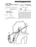 DOUBLE SOCKET ACL RECONSTRUCTION diagram and image