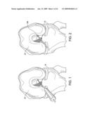 DOUBLE SOCKET ACL RECONSTRUCTION diagram and image