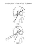 DOUBLE SOCKET ACL RECONSTRUCTION diagram and image