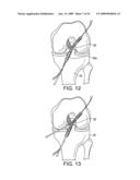 DOUBLE SOCKET ACL RECONSTRUCTION diagram and image