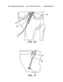 DOUBLE SOCKET ACL RECONSTRUCTION diagram and image