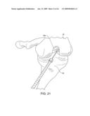 DOUBLE SOCKET ACL RECONSTRUCTION diagram and image