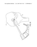 DOUBLE SOCKET ACL RECONSTRUCTION diagram and image