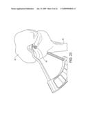 DOUBLE SOCKET ACL RECONSTRUCTION diagram and image