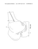 DOUBLE SOCKET ACL RECONSTRUCTION diagram and image