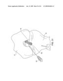 DOUBLE SOCKET ACL RECONSTRUCTION diagram and image