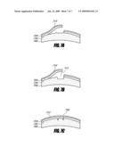 SYSTEM AND METHOD FOR INCREASING THE DEPTH OF FOCUS OF THE HUMAN EYE diagram and image