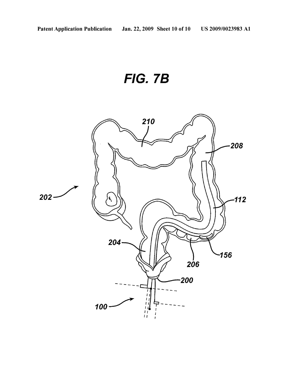 SURGICAL METHODS AND DEVICES WITH MOVEMENT ASSISTANCE - diagram, schematic, and image 11