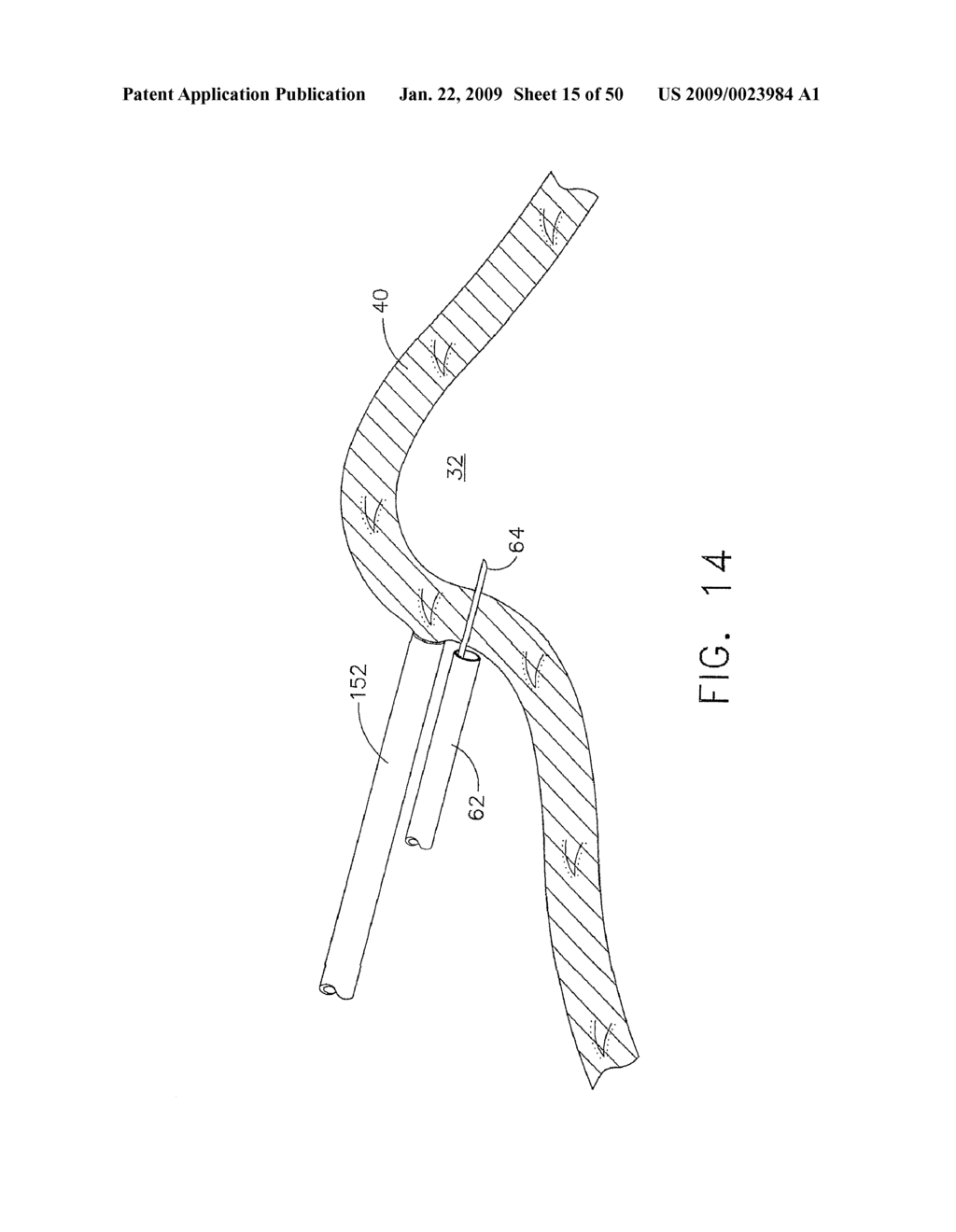 DEVICE FOR INSUFFLATING THE INTERIOR OF A GASTRIC CAVITY OF A PATIENT - diagram, schematic, and image 16