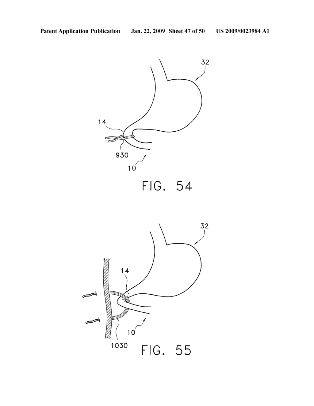 DEVICE FOR INSUFFLATING THE INTERIOR OF A GASTRIC CAVITY OF A PATIENT - diagram, schematic, and image 48