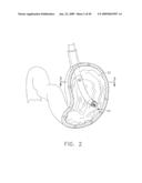  DEVICE FOR INSUFFLATING THE INTERIOR OF A GASTRIC CAVITY OF A PATIENT diagram and image