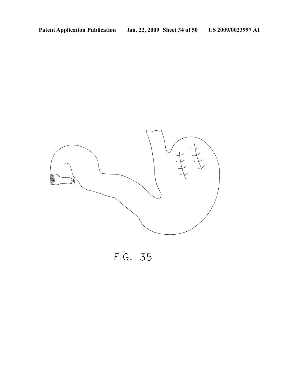  DEVICE FOR INSUFFLATING THE INTERIOR OF A GASTRIC CAVITY OF A PATIENT - diagram, schematic, and image 35