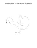  DEVICE FOR INSUFFLATING THE INTERIOR OF A GASTRIC CAVITY OF A PATIENT diagram and image