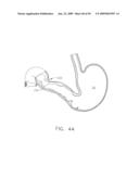  DEVICE FOR INSUFFLATING THE INTERIOR OF A GASTRIC CAVITY OF A PATIENT diagram and image