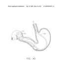  DEVICE FOR INSUFFLATING THE INTERIOR OF A GASTRIC CAVITY OF A PATIENT diagram and image