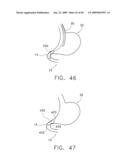  DEVICE FOR INSUFFLATING THE INTERIOR OF A GASTRIC CAVITY OF A PATIENT diagram and image