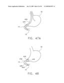  DEVICE FOR INSUFFLATING THE INTERIOR OF A GASTRIC CAVITY OF A PATIENT diagram and image