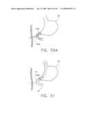  DEVICE FOR INSUFFLATING THE INTERIOR OF A GASTRIC CAVITY OF A PATIENT diagram and image