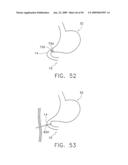  DEVICE FOR INSUFFLATING THE INTERIOR OF A GASTRIC CAVITY OF A PATIENT diagram and image