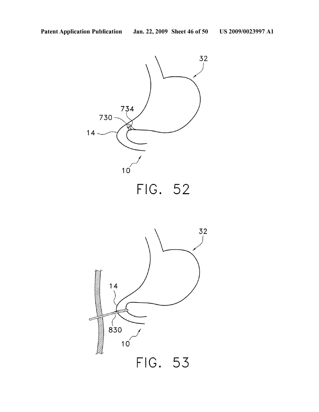  DEVICE FOR INSUFFLATING THE INTERIOR OF A GASTRIC CAVITY OF A PATIENT - diagram, schematic, and image 47