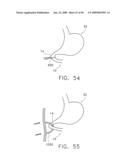  DEVICE FOR INSUFFLATING THE INTERIOR OF A GASTRIC CAVITY OF A PATIENT diagram and image