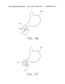  DEVICE FOR INSUFFLATING THE INTERIOR OF A GASTRIC CAVITY OF A PATIENT diagram and image