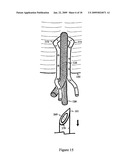 U-Shaped Disc Shunt and Delivery Device diagram and image