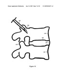 U-Shaped Disc Shunt and Delivery Device diagram and image