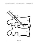 U-Shaped Disc Shunt and Delivery Device diagram and image