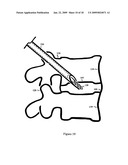 U-Shaped Disc Shunt and Delivery Device diagram and image