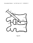 U-Shaped Disc Shunt and Delivery Device diagram and image