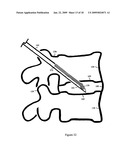 U-Shaped Disc Shunt and Delivery Device diagram and image