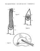 U-Shaped Disc Shunt and Delivery Device diagram and image