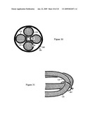 U-Shaped Disc Shunt and Delivery Device diagram and image