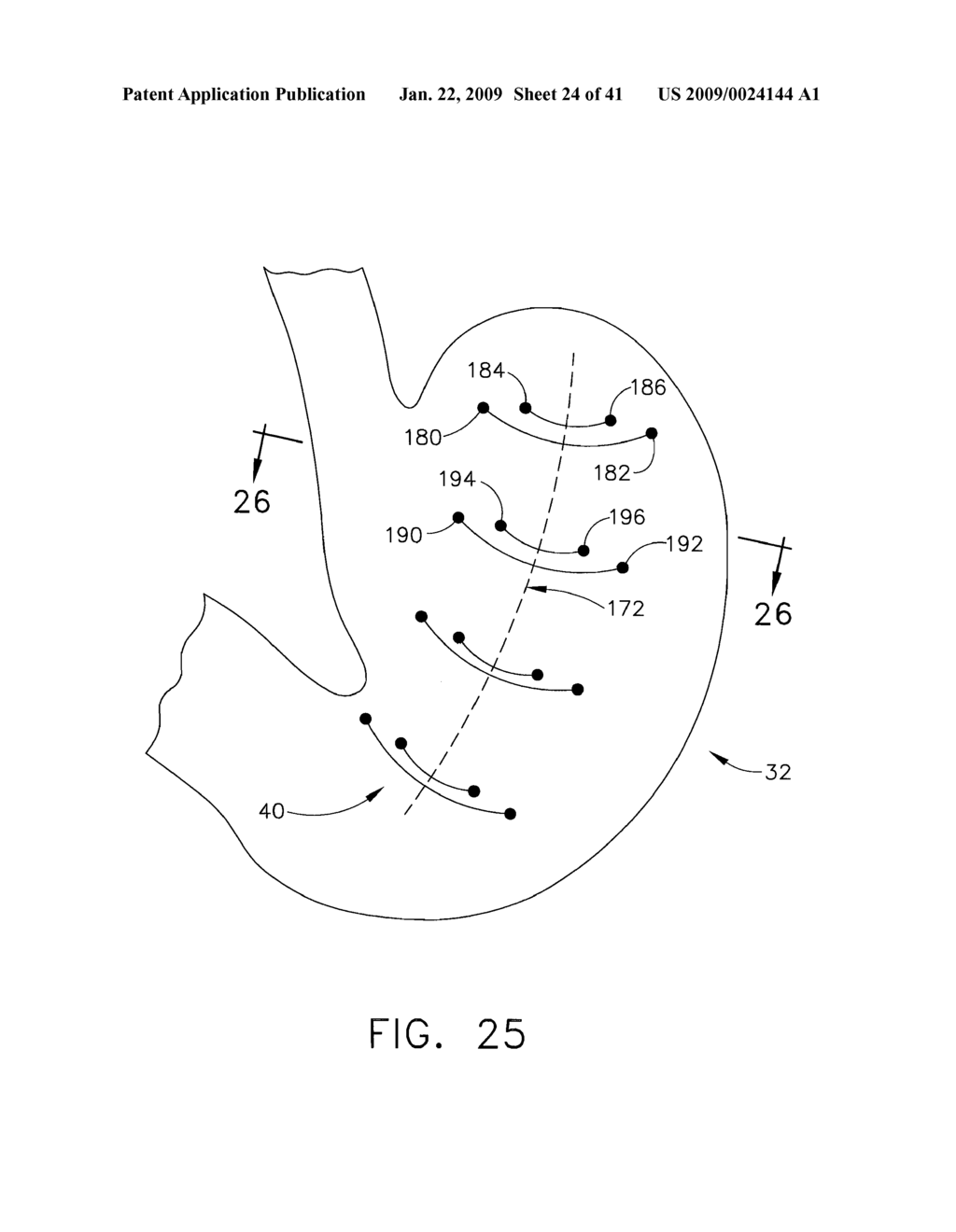 HYBRID ENDOSCOPIC/LAPAROSCOPIC DEVICE FOR FORMING SEROSA TO SEROSA PLICATIONS IN A GASTRIC CAVITY - diagram, schematic, and image 25