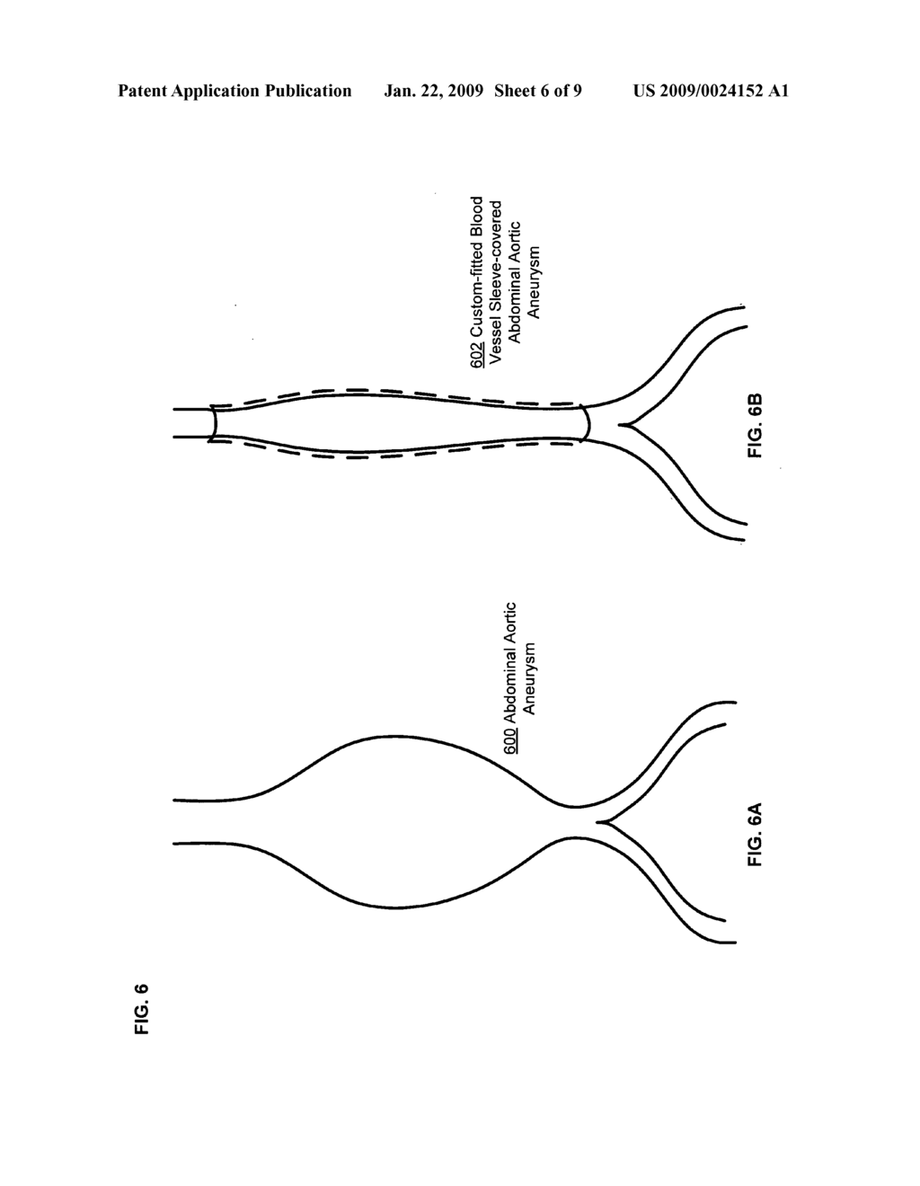 Custom-fitted blood vessel sleeve - diagram, schematic, and image 07