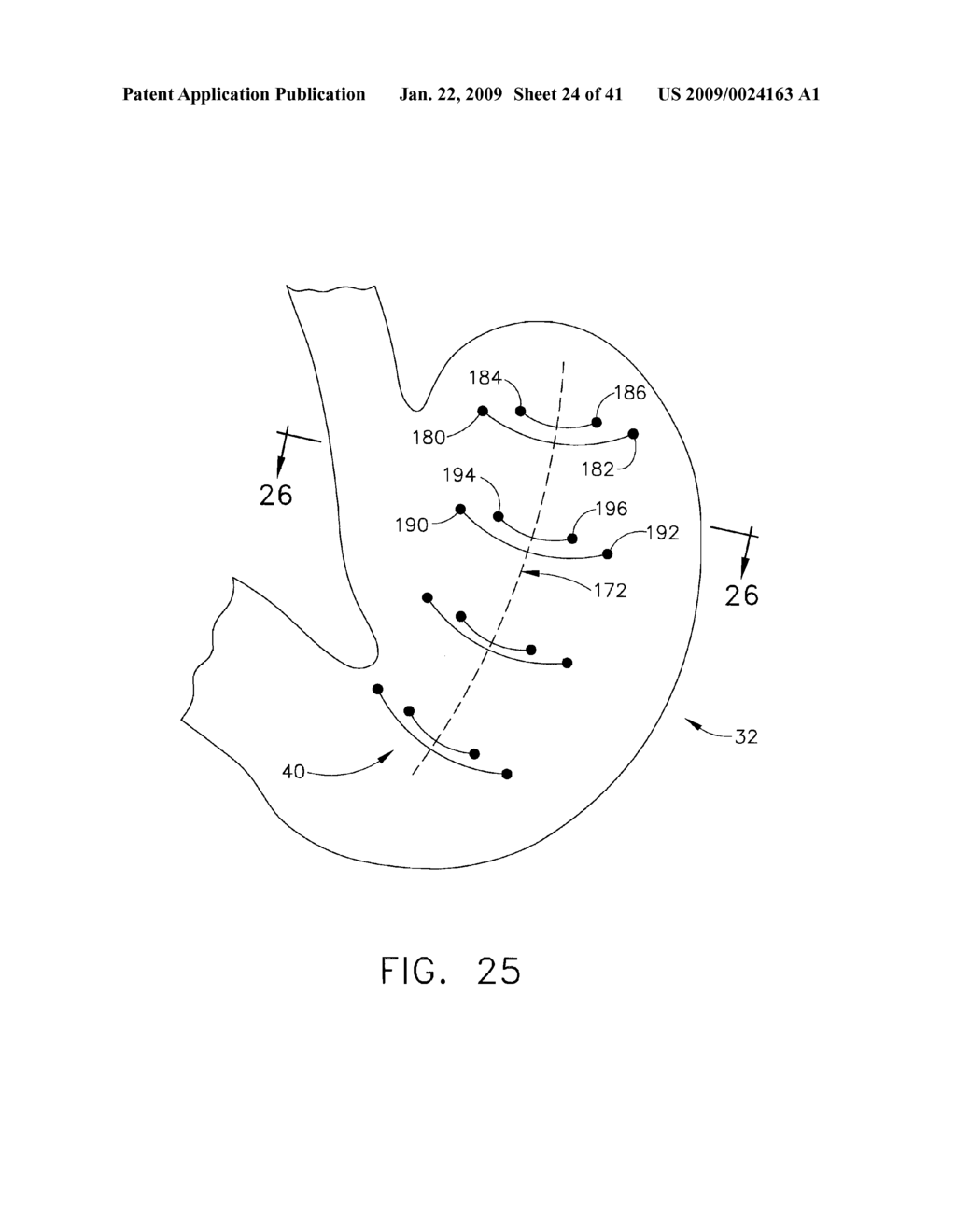 HYBRID ENDOSCOPIC/LAPAROSCOPIC METHOD FOR FORMING SEROSA TO SEROSA PLICATIONS IN A GASTRIC CAVITY - diagram, schematic, and image 25