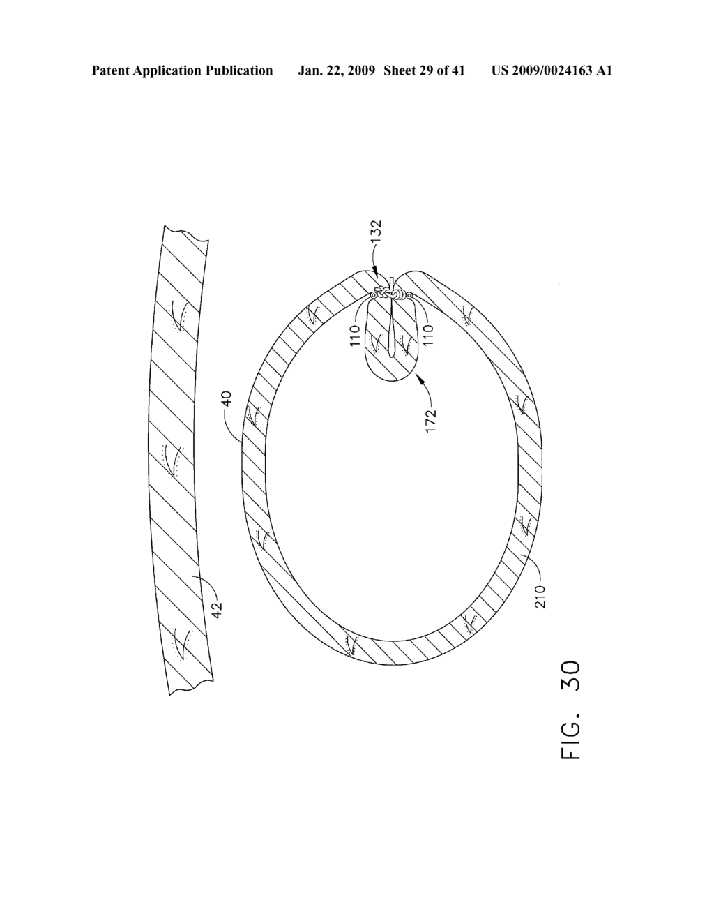 HYBRID ENDOSCOPIC/LAPAROSCOPIC METHOD FOR FORMING SEROSA TO SEROSA PLICATIONS IN A GASTRIC CAVITY - diagram, schematic, and image 30