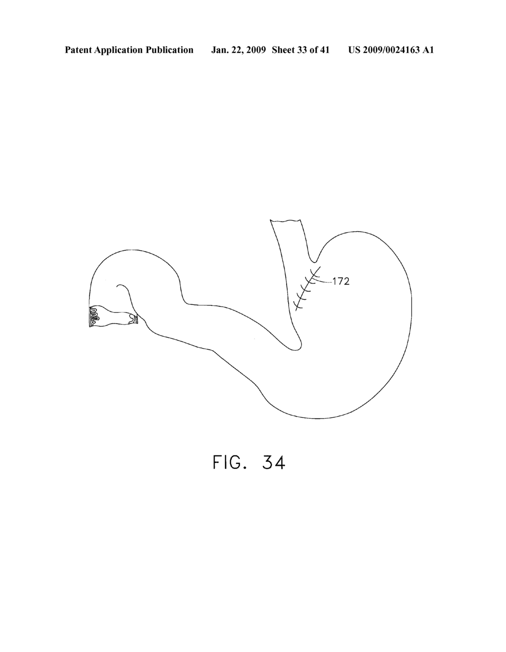 HYBRID ENDOSCOPIC/LAPAROSCOPIC METHOD FOR FORMING SEROSA TO SEROSA PLICATIONS IN A GASTRIC CAVITY - diagram, schematic, and image 34