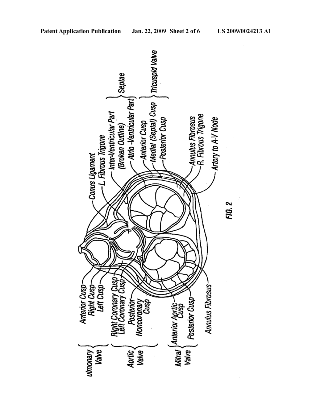 Method and Apparatus for External Stabilization of the Heart Valves and Myocardium - diagram, schematic, and image 03