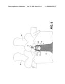 SPINAL DISC ANNULUS RECONSTRUCTION METHOD AND SPINAL DISC ANNULUS STENT diagram and image