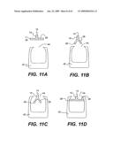 SPINAL DISC ANNULUS RECONSTRUCTION METHOD AND SPINAL DISC ANNULUS STENT diagram and image