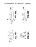 SPINAL DISC ANNULUS RECONSTRUCTION METHOD AND SPINAL DISC ANNULUS STENT diagram and image