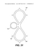 SPINAL DISC ANNULUS RECONSTRUCTION METHOD AND SPINAL DISC ANNULUS STENT diagram and image