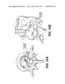 SPINAL DISC ANNULUS RECONSTRUCTION METHOD AND SPINAL DISC ANNULUS STENT diagram and image