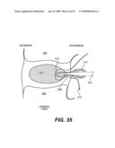 SPINAL DISC ANNULUS RECONSTRUCTION METHOD AND SPINAL DISC ANNULUS STENT diagram and image