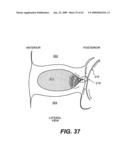 SPINAL DISC ANNULUS RECONSTRUCTION METHOD AND SPINAL DISC ANNULUS STENT diagram and image